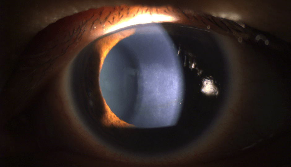 what is fuchs dystrophy of the eye