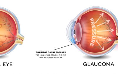 Glaucoma Recovery