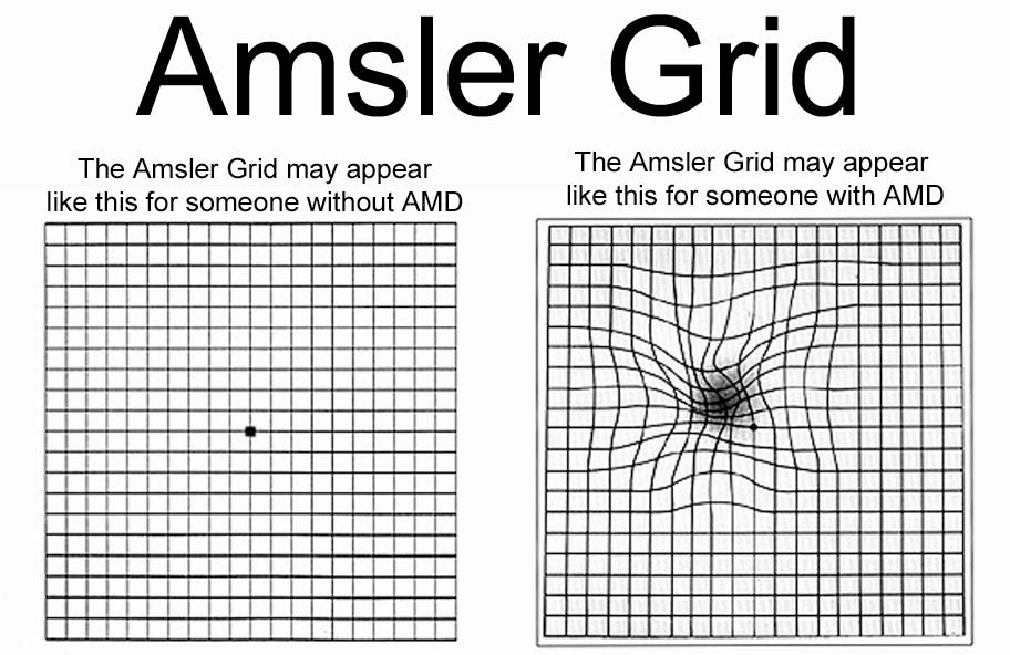 Amsler Grid