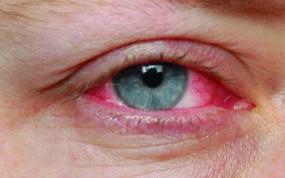 Conjunctivitis Recovery