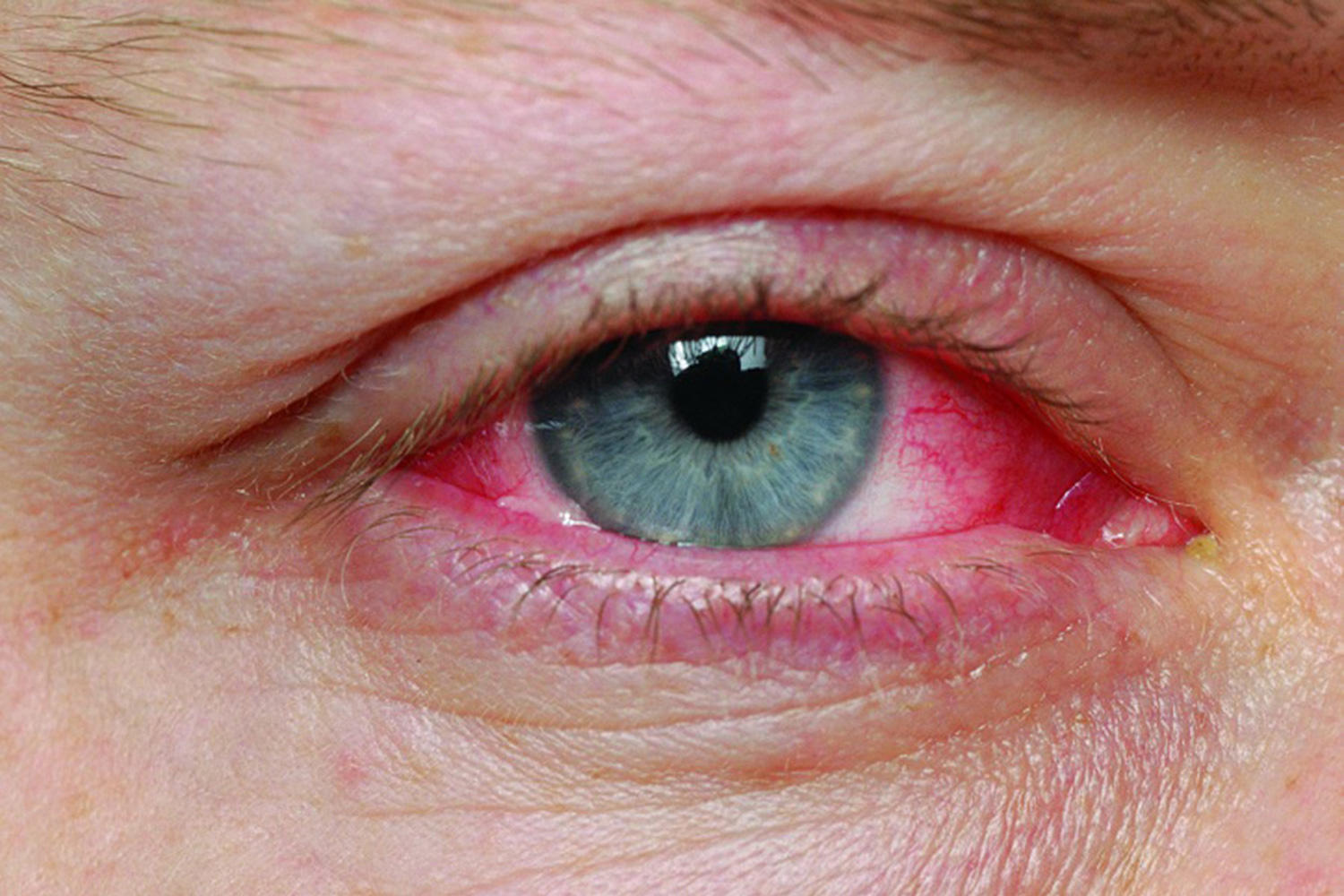 Can Pink Eye Cause Temporary Blindness